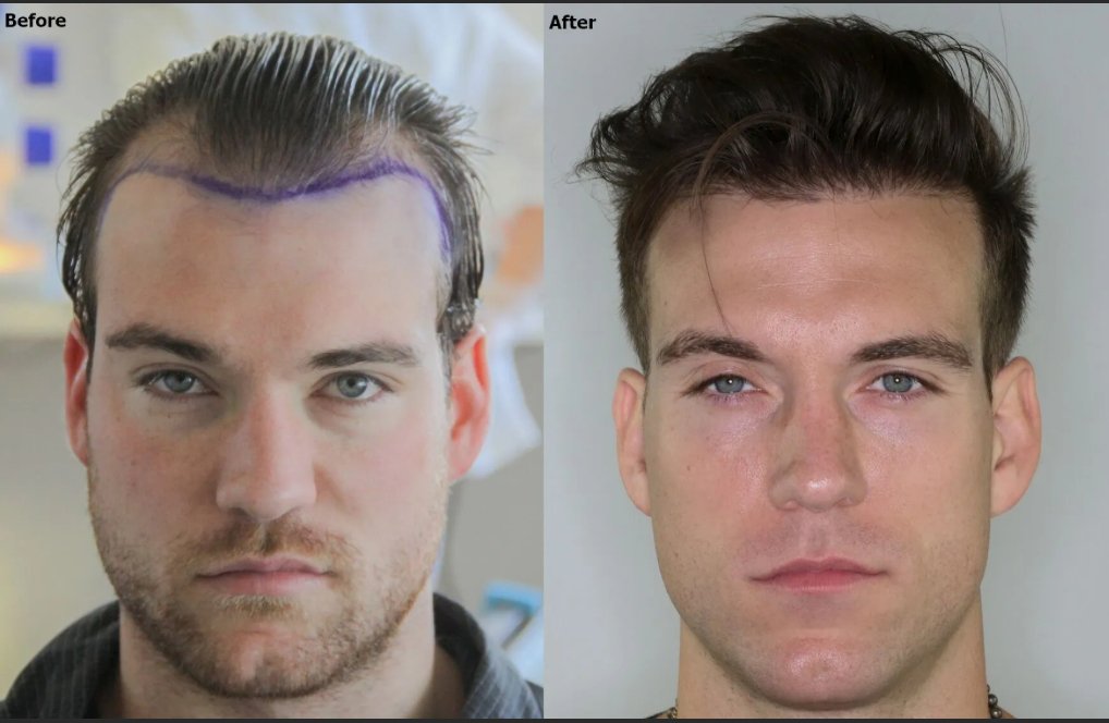 Image Provided By AlviArmani. All Rights Reserved. Before After Hair Transplant. 