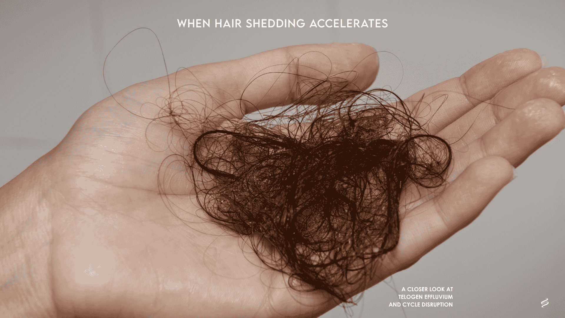 Diffuse hair shedding collected in hand showing telogen effluvium hair fall pattern