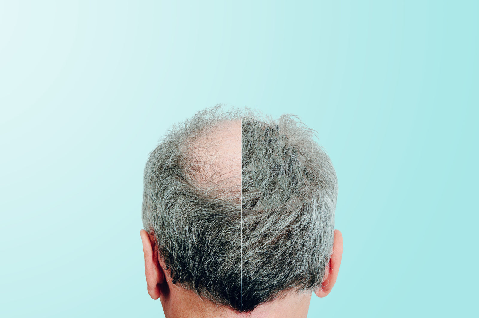 Hair Loss In Men. Analysis and Solutions. 