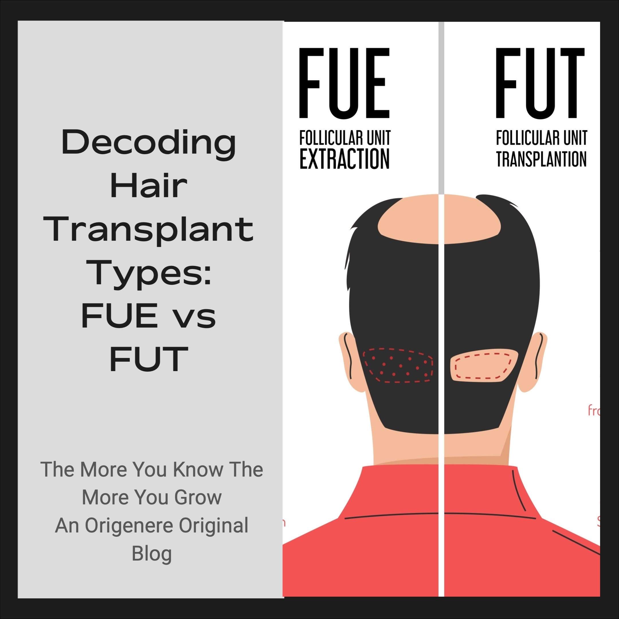 Decoding Hair Transplant Types: FUE vs FUT