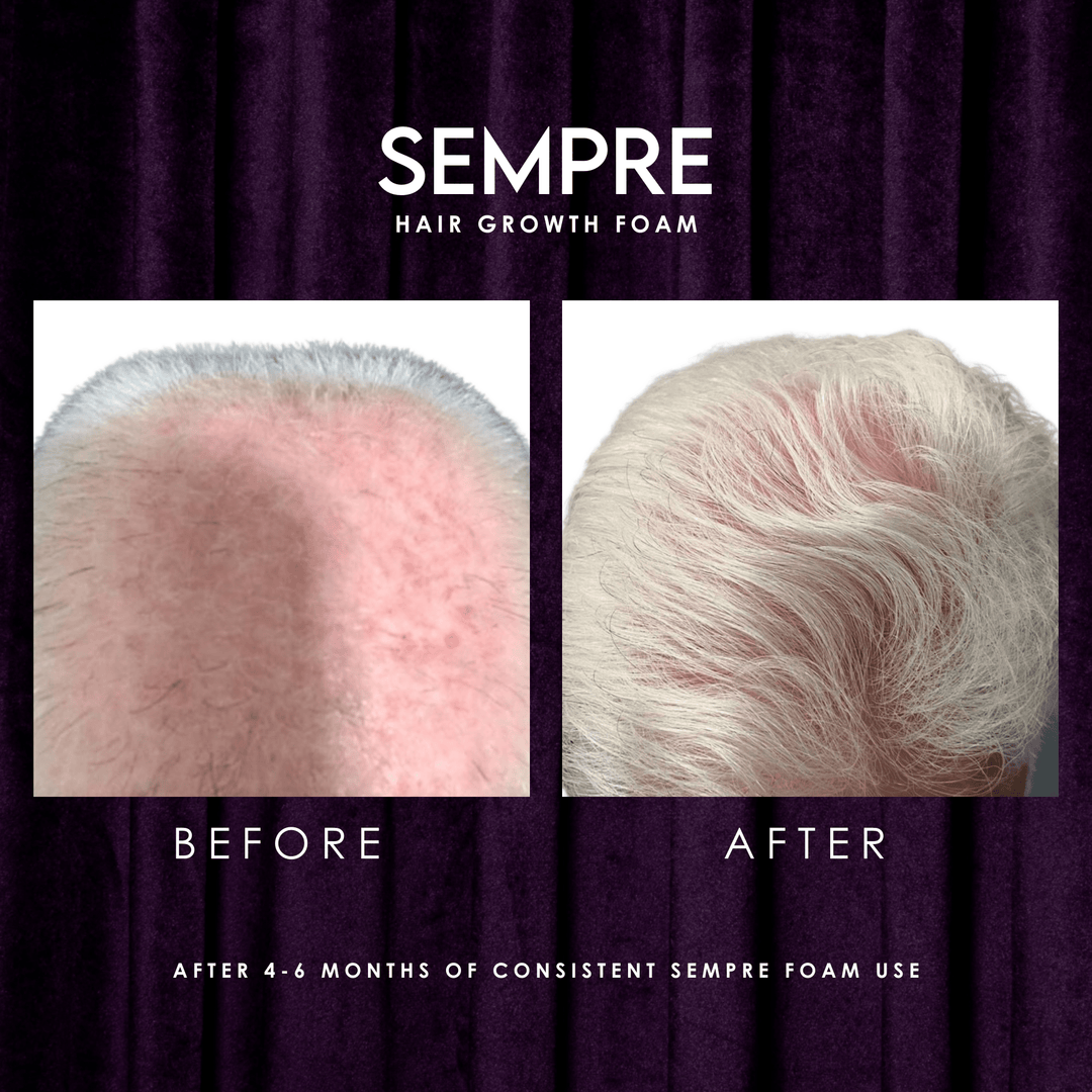 Sempre Hair Growth Foam Before And After