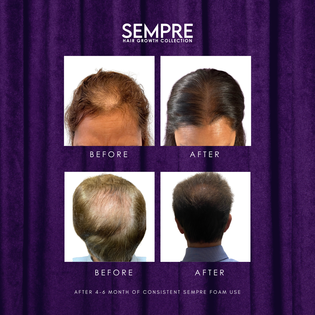 Sempre Hair Growth Foam Before and After Pictures